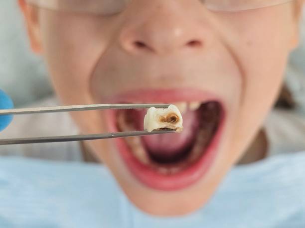 Best Emergency Dentist for Knocked-Out Tooth in Prairie Ridge, WA